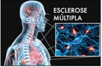 Esclerose múltipla: novos medicamentos garantem qualidade de vida aos pacientes