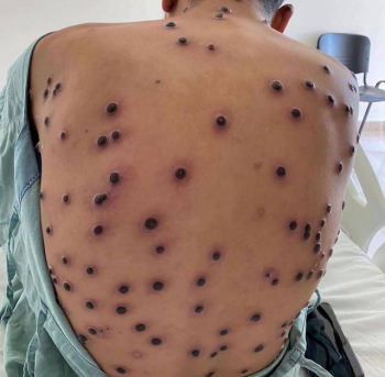 Casos de Mpox dobram em Minas em menos de duas semanas; BH concentra 80% dos registros