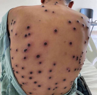 Casos de Mpox dobram em Minas em menos de duas semanas; BH concentra 80% dos registros