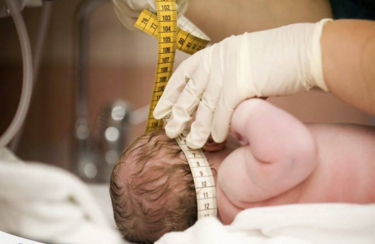 Geral: Vírus bovino é encontrado em tecidos de bebês com microcefalia