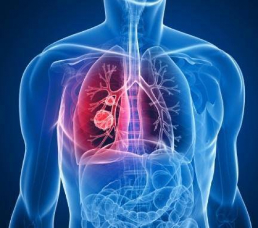 Quantidade de casos de Pneumonia preocupa população guanhanense