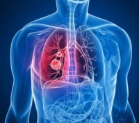 Quantidade de casos de Pneumonia preocupa população guanhanense
