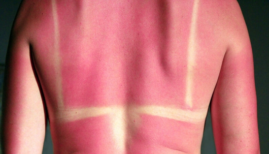 ESPECIAL DE VERÃO: Exagerou no sol? Saiba como cuidar da pele após a intensa exposição