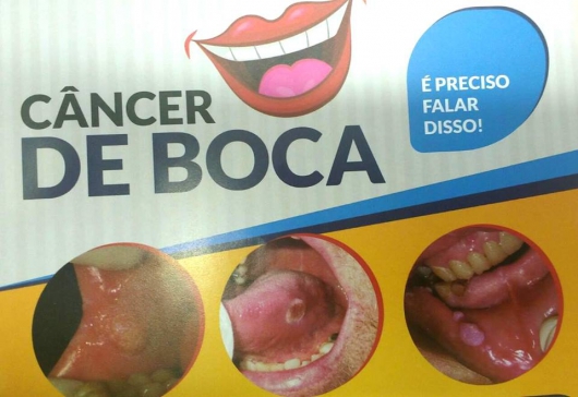 Campanha de Prevenção contra o Câncer de Boca será realizado neste sábado em Guanhães