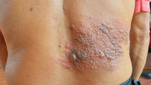 Consulta pública avalia inclusão de vacina contra herpes zóster no SUS