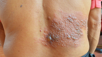 Consulta pública avalia inclusão de vacina contra herpes zóster no SUS